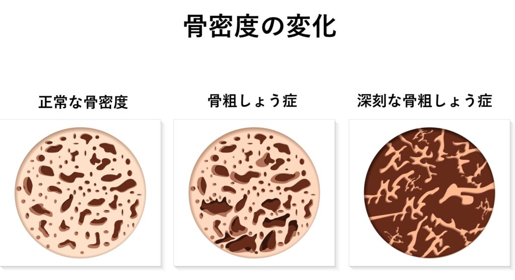 一部の方法は骨粗鬆症のリスクを高める可能性があります