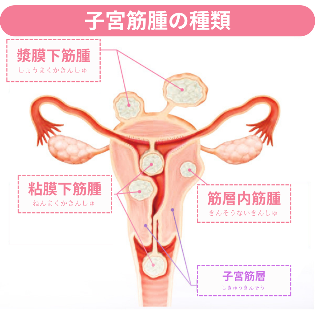 子宮筋腫の原因は性行為のやりすぎ？その症状・検査治療法・性行為や妊娠等の悩みを女医が丁寧に解説。 – 港区、品川区の産婦人科で妊婦 健診・産後ケア・避妊相談なら│海老根ウィメンズクリニック