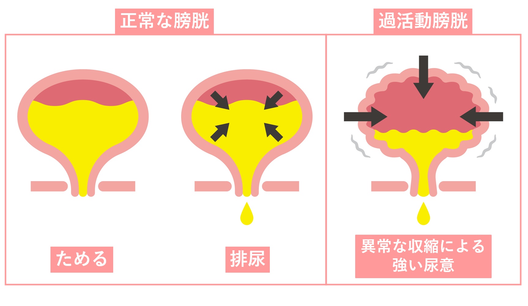 婦人　おしっこ 女性の過活動膀胱」原因はストレス？症状・治療法・お薬など尿漏れトラブルを女医が丁寧に解説。 – 港区、品川区の産婦人科 で妊婦健診・産後ケア・避妊相談なら│海老根ウィメンズクリニック