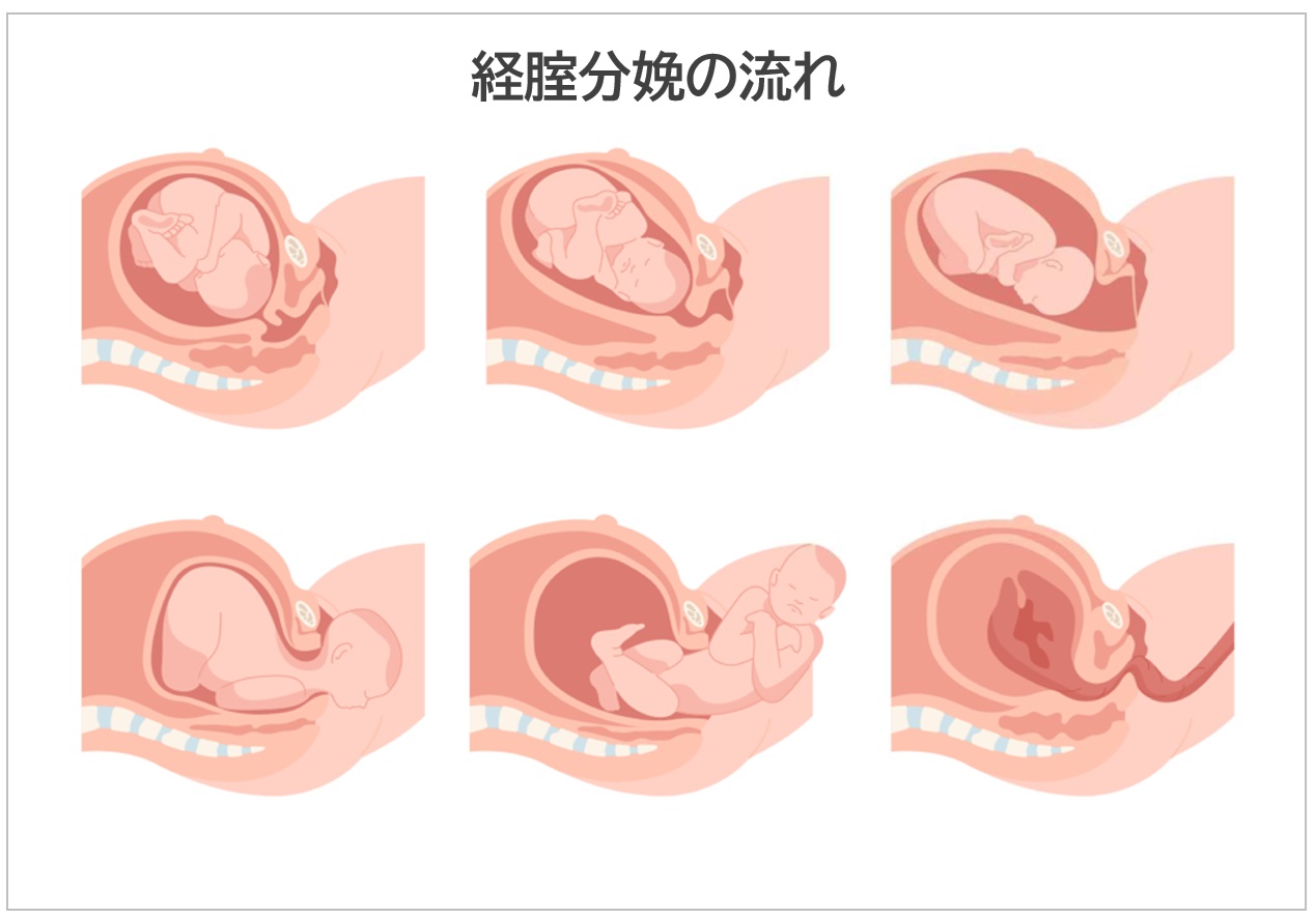 経膣分娩