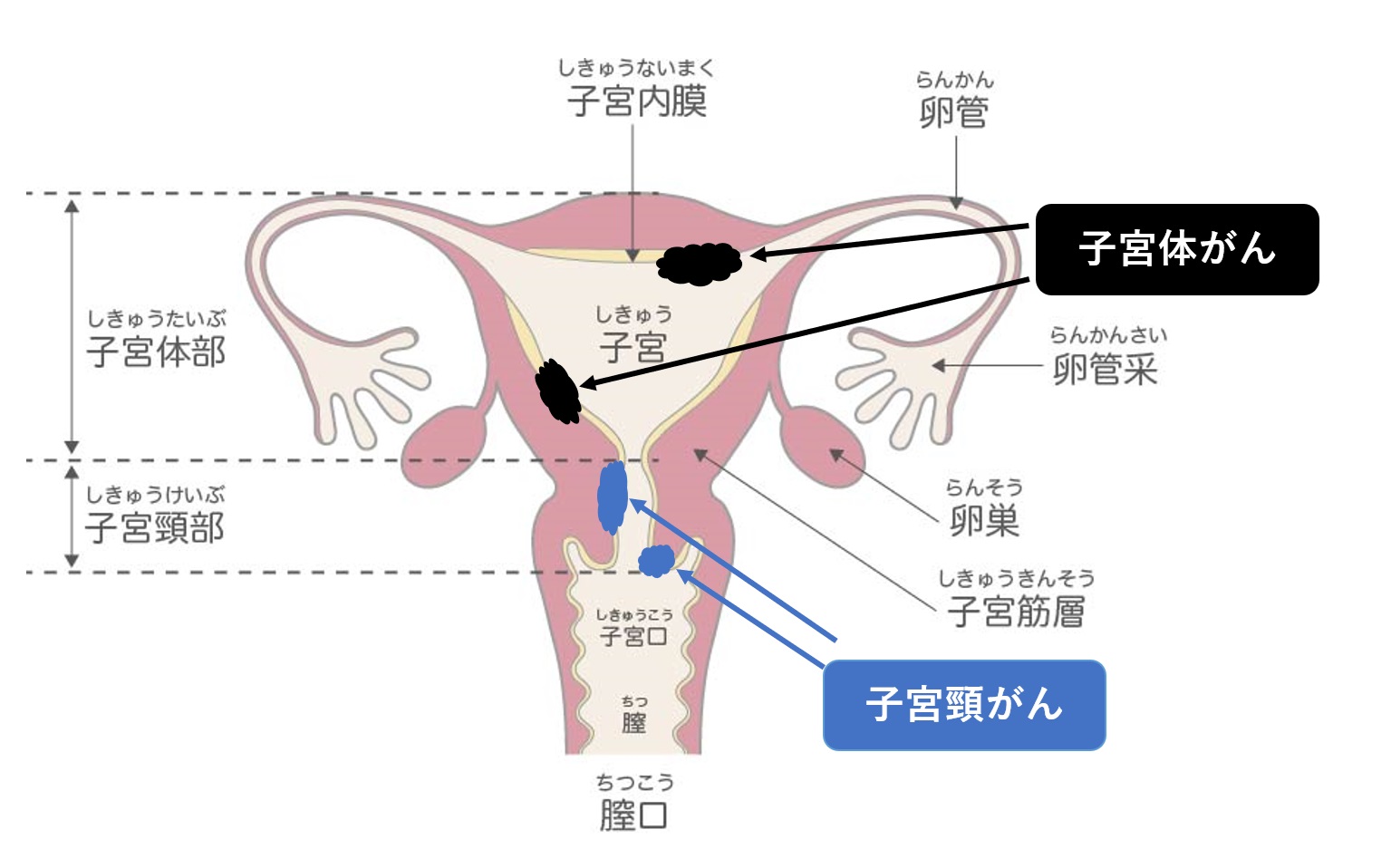 子宮口 