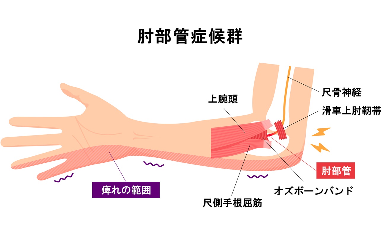 肘部管症候群