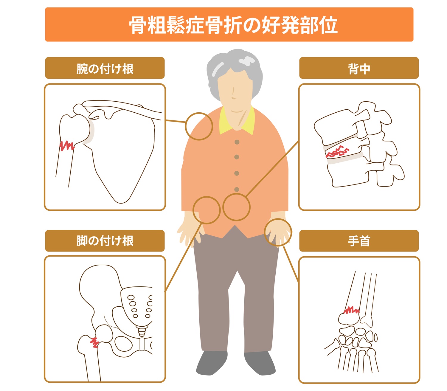 肘部管症候群