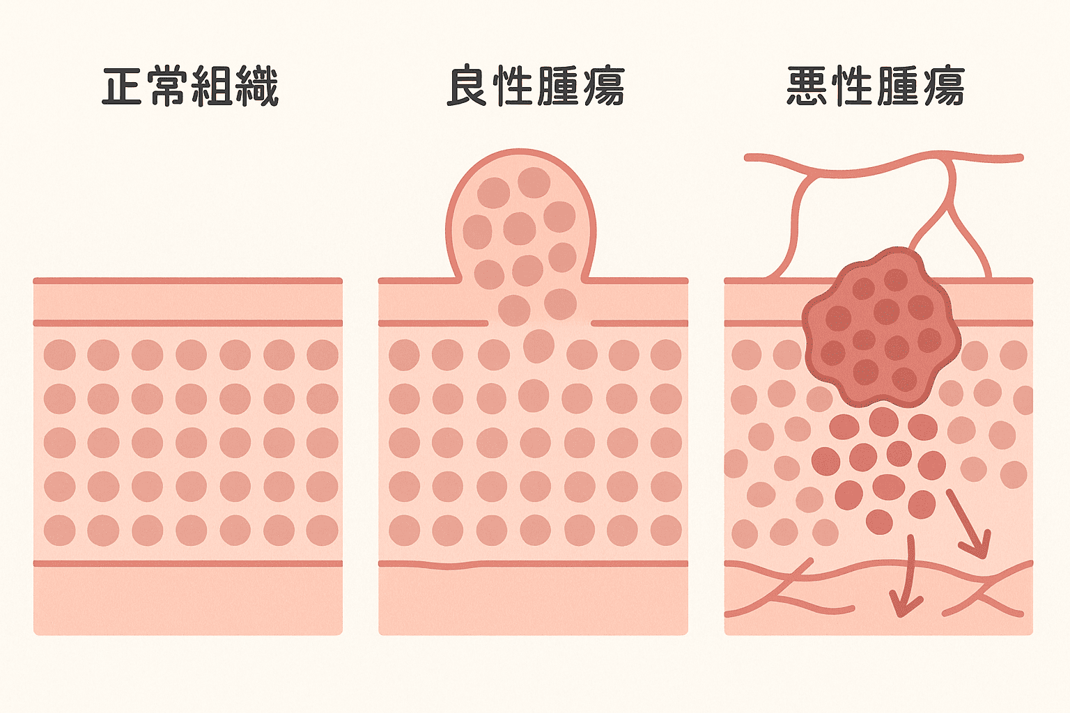 外陰部のしこり・腫れは腫瘍？脂肪腫・線維腫から外陰がんの見分け方と治療・受診の目安を婦人科医が解説。 – 港区、品川区の産婦人科で妊婦健診 ...