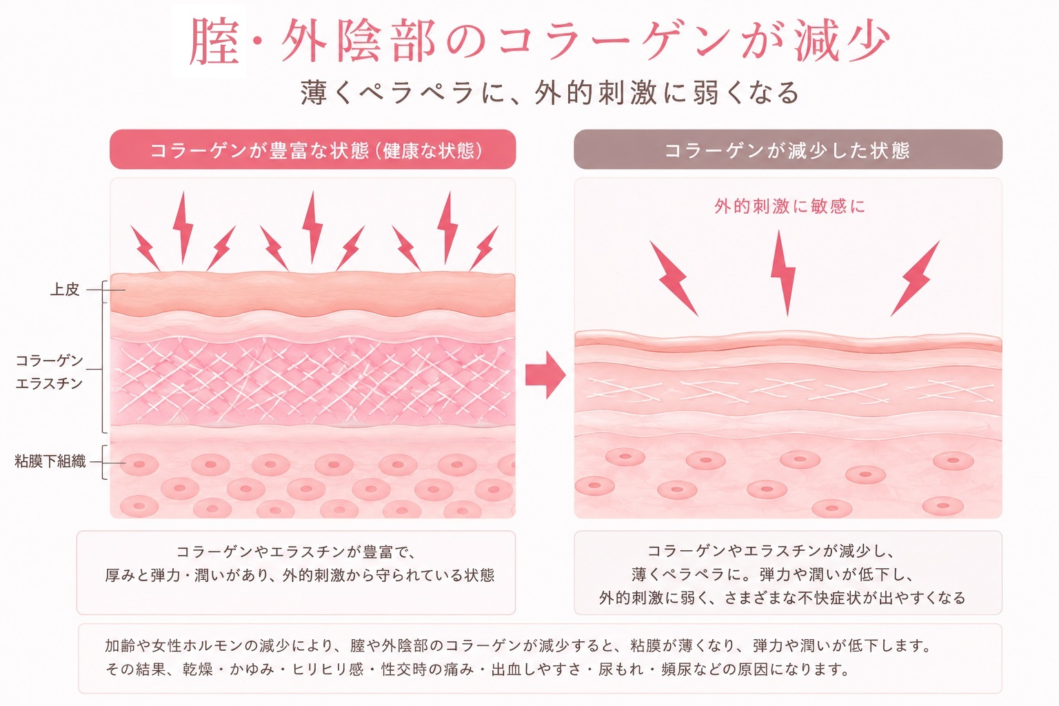 モナリザタッチ（腟レーザー治療） – 港区、品川区の産婦人科で妊婦健 