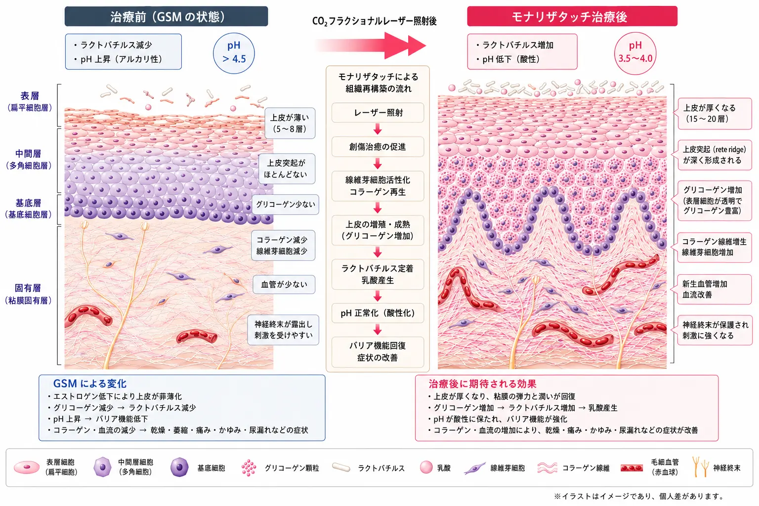 GSMによる腟粘膜の変化とモナリザタッチ治療後の組織再構築を比較した院長作成図