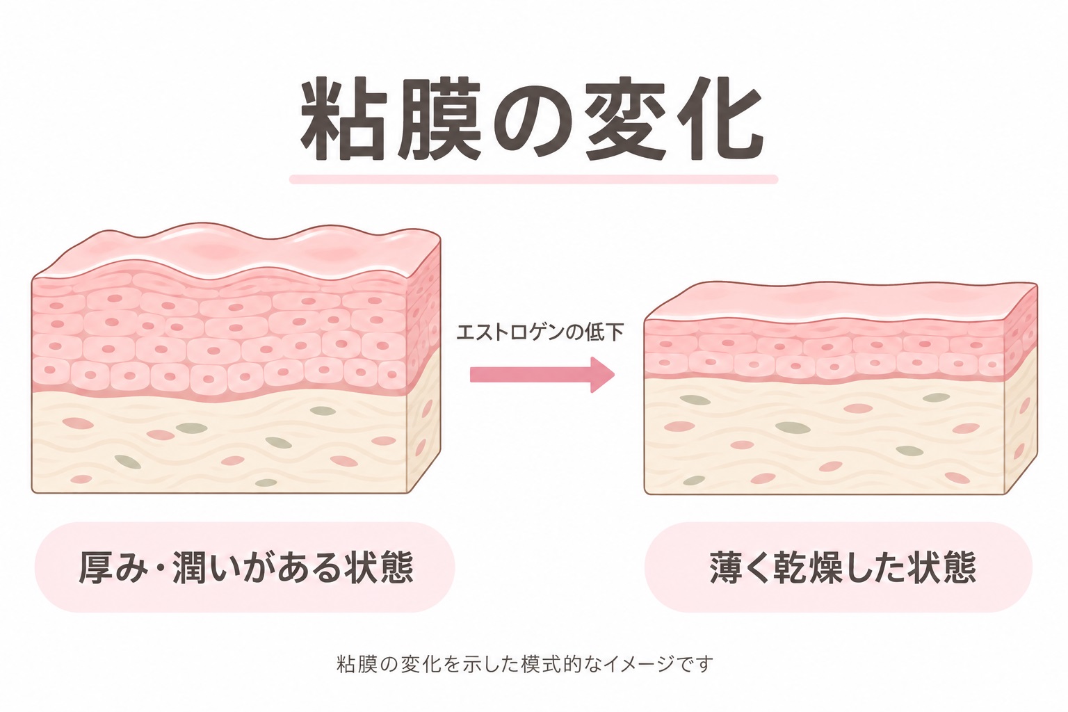エストロゲン減少による腟粘膜の変化
